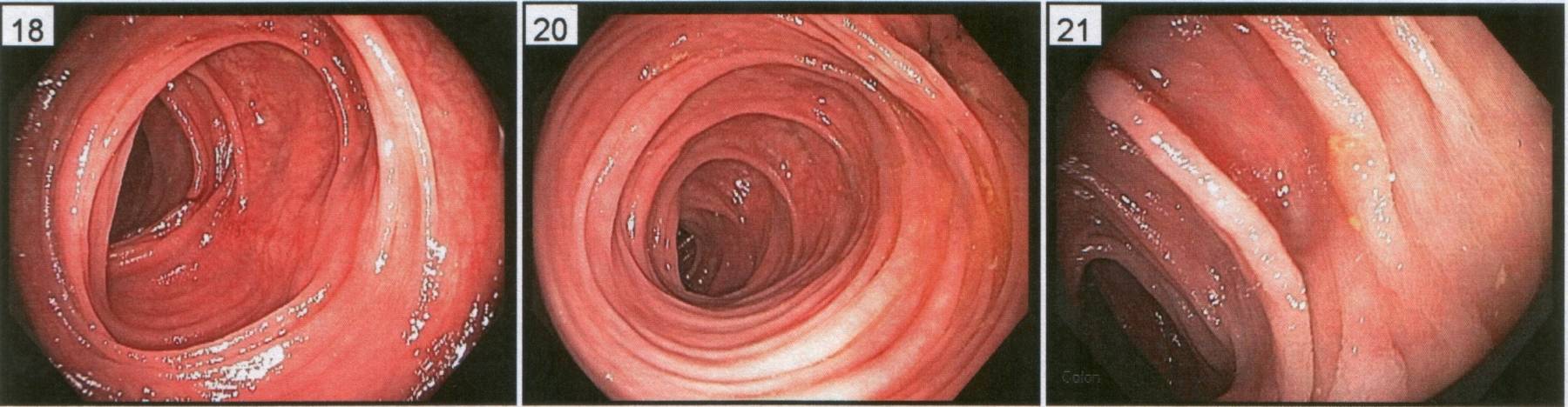 Endoscopic images of the transverse colon.